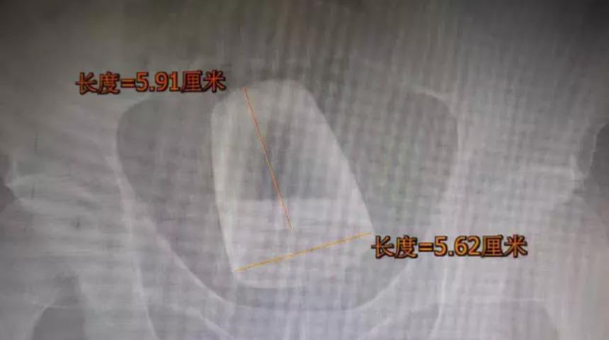 Makatına bira bardağı 'sıkıştığını' iddia etti!