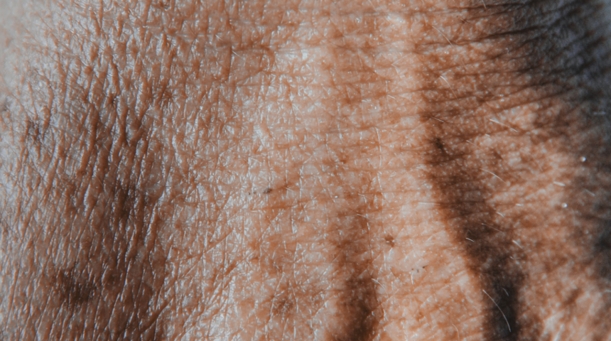 Bir t&uuml;rl&uuml; ge&ccedil;meyen g&uuml;neş lekelerinden nasıl kurturulur? İşte ger&ccedil;ek &ccedil;&ouml;z&uuml;m