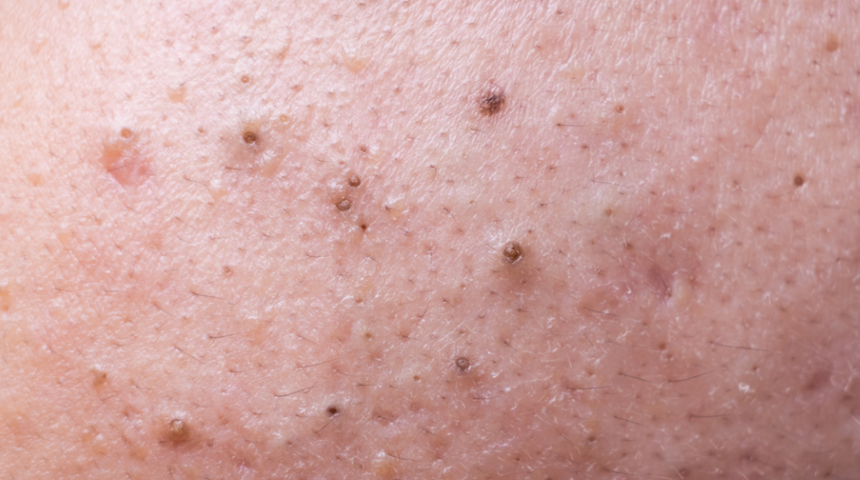 Burun bantlarına elvada deyin! Siyah noktaları kökünden çözeceksiniz