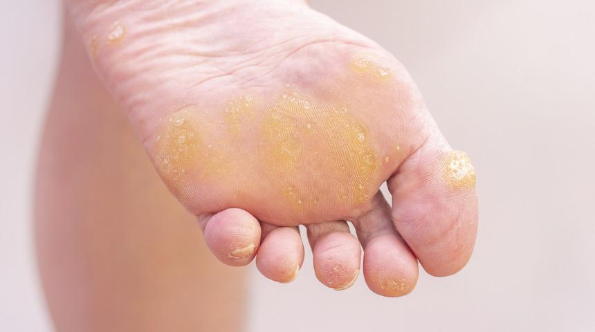 Bir günde nasır çilesinden kurtulun! Nasıl mı?