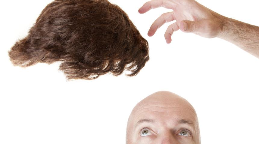 Bölgesel saç dökülmelerinde protez saç uygulanır mı?