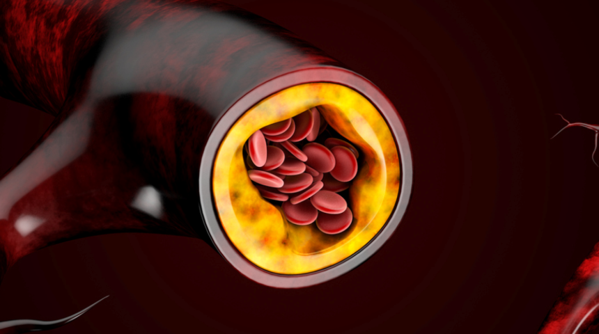 Sessiz ilerleyebilir! Kolesterolün en önemli belirtileri...