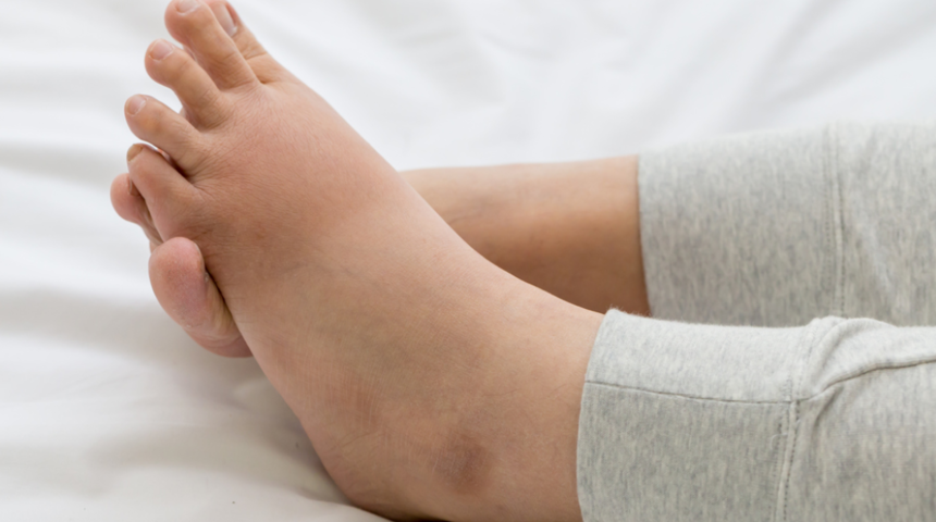 Ödeme dikkat! Vücutta neden ödem oluşur, hangi hastalıkların habercisi?