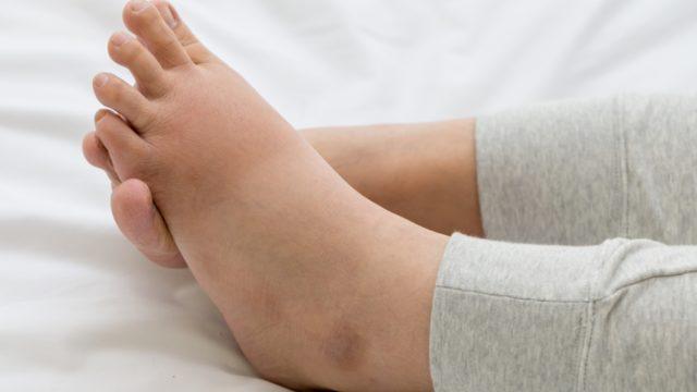 Ödeme dikkat! Vücutta neden ödem oluşur, hangi hastalıkların habercisi?