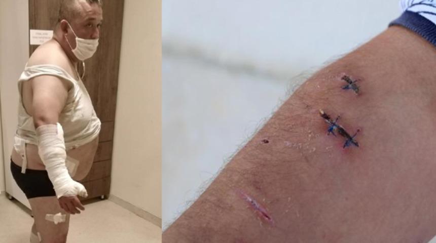 Oteldeki pitbull'ların saldırısına uğradı! 40 dikiş atılıp, 100 iğne yapıldı