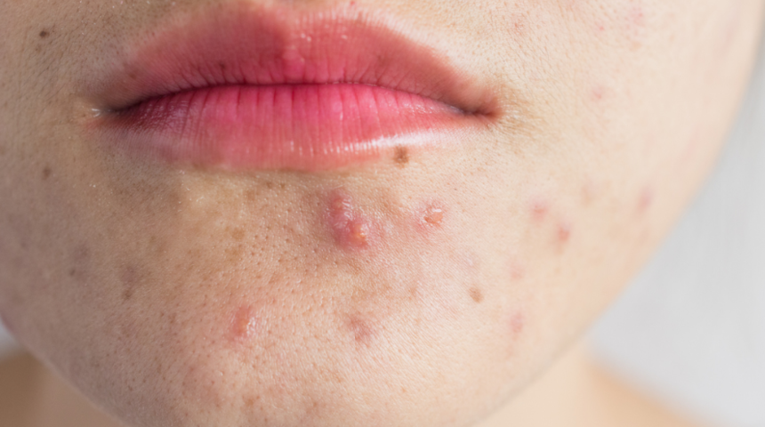 Ölümcül üçgene dikkat! Bu bölgedeki sivilceyi sıkmayın