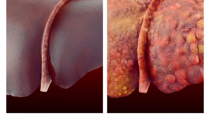 Gencinden yaşlısına herkes yakalanabilir! Karaciğerin fonksiyonlarını bozuyor