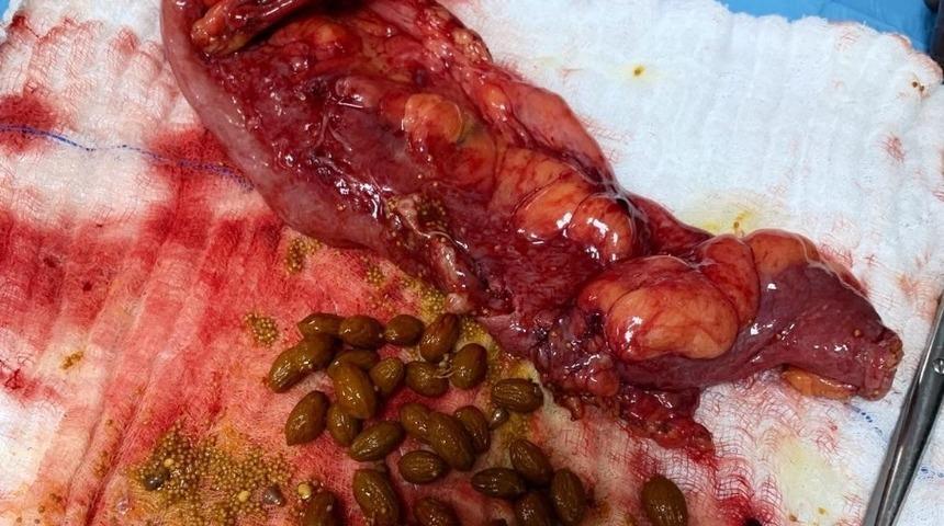 Şoke eden g&ouml;r&uuml;nt&uuml;! Karnından &ccedil;ıkanlar doktorları bile şaşırttı