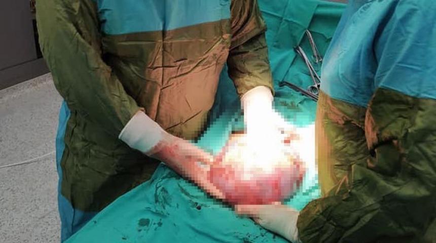 Şoke eden görüntü! Karnından futbol topu büyüklüğünde kitle çıktı