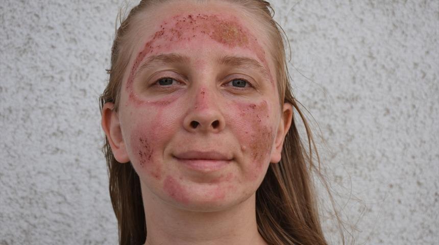 G&uuml;zellik merkezinde bakım yaptırdıktan sonra y&uuml;z&uuml;nde yanıklar oluştu