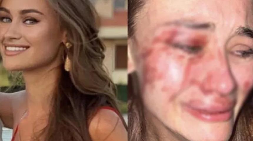 Çeşme'de darp edildiğini iddia eden Daria Kyryliuk koronavirüse yakalandı