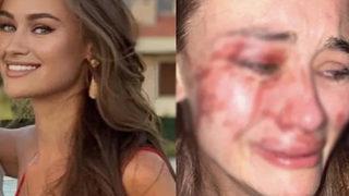 Çeşme'de darp edildiğini iddia eden Daria Kyryliuk koronavirüse yakalandı