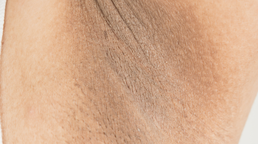 Koltuk altı kararmasını silgi gibi ortadan kaldıracaksınız! İşte 8 çözüm yolu