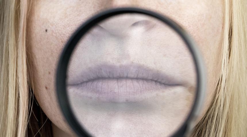 Dudak kenarlarındaki morarmalara dikkat! Hafife almayın