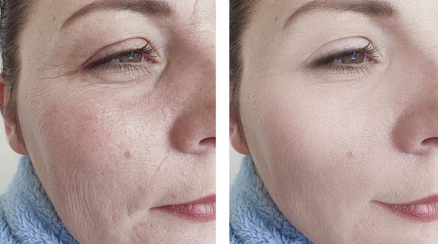 Yüzünüzdeki yaşlanma belirtilerine evde yapabileceğiniz bu kremle veda edin!  