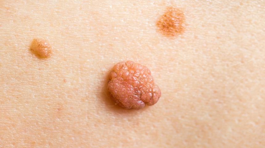 Et benlerini patır patır d&ouml;ken en doğal &ccedil;&ouml;z&uuml;mler