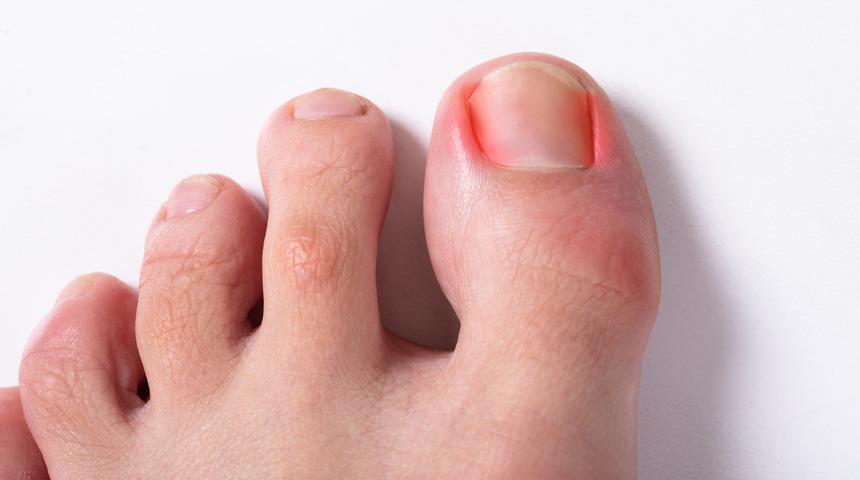 Tırnak batması tedavisi evde yapılabilir mi? İşte tırnak batması tedavisinde kalıcı çözüm