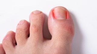 Tırnak batması tedavisi evde yapılabilir mi? İşte tırnak batması tedavisinde kalıcı çözüm