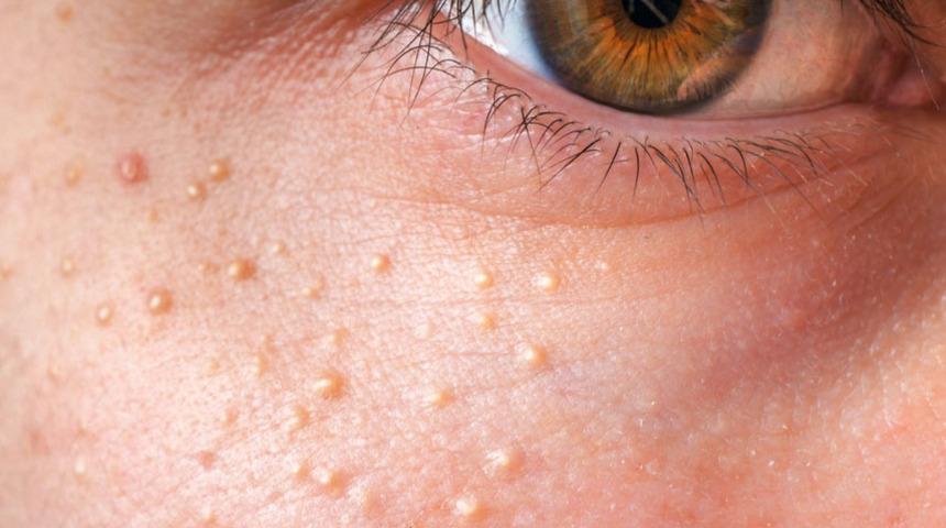 Sivilce değil akne değil! G&ouml;z &ccedil;evresindeki bezeler ne anlama geliyor?