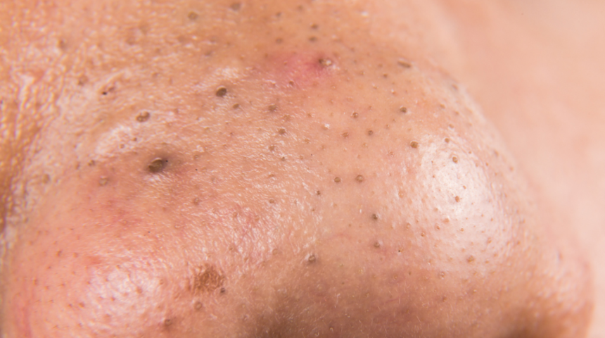 Akneden nasıl kurtulunur? 5 &ouml;nemli &ouml;neri!