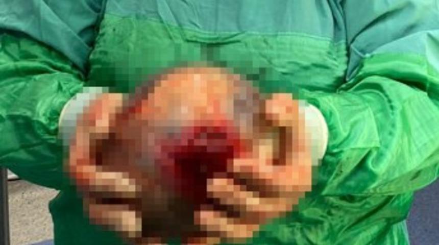 Rahminden 1,5 kiloluk kist çıktı! Doktorlar bile şaşırdı