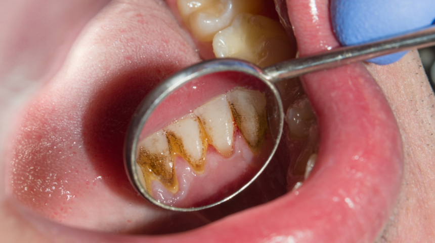 Bu hatalar dişlerimizi par&ccedil;a par&ccedil;a yok ediyor! Yemekten hemen sonra bunu yapmak...