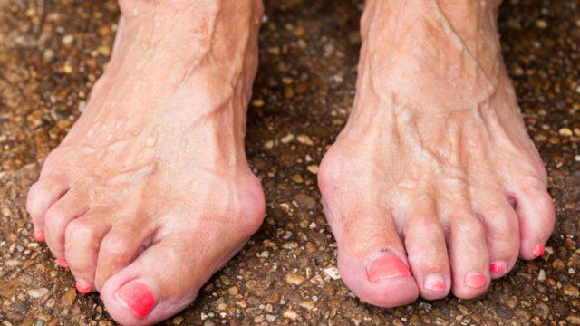 En sık kadınlarda görülüyor! Ağrılı hale geldiğinde dikkat