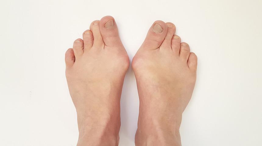 Özellikle kadınları tehdit ediyor! Ayak başparmağında çıkıntı varsa...