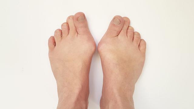 Özellikle kadınları tehdit ediyor! Ayak başparmağında çıkıntı varsa...