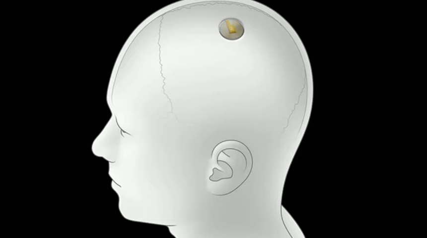 İlgin&ccedil; araştırma: T&uuml;rk halkı beynine Neuralink &ccedil;ipi taktırır mı?