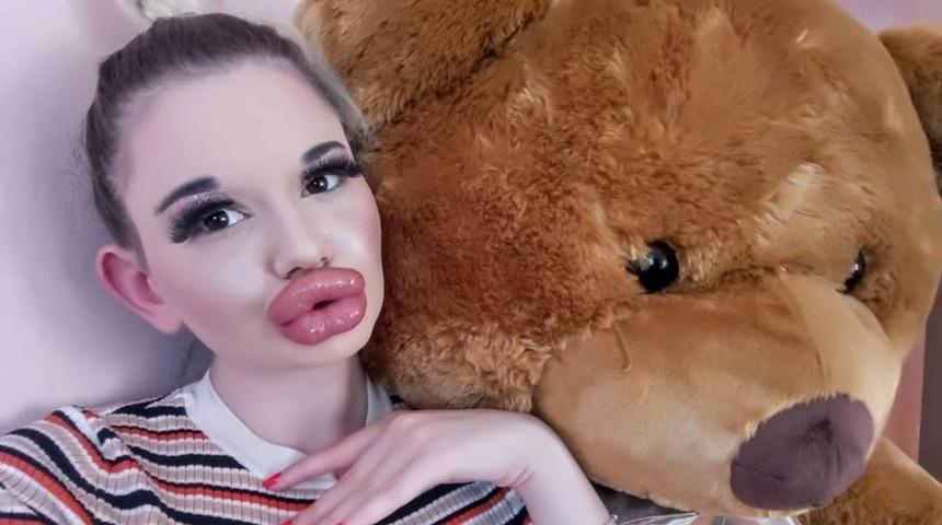 Dudak dolgusu bağımlısı, 'd&uuml;nyanın en b&uuml;y&uuml;k' dudaklarına sahip olmak i&ccedil;in uyarıları g&ouml;rmezden geliyor 