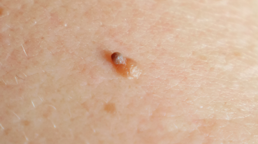 Utanıp sıkılmayın! Zamanında müdahale edilmezse...