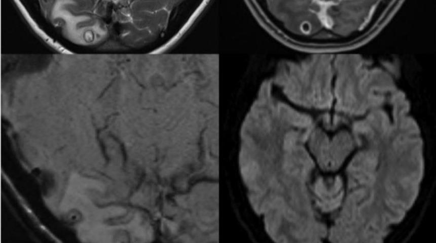 Doktorlar baş ağrısından şikayet eden kadının beyninde tenya larvası buldu