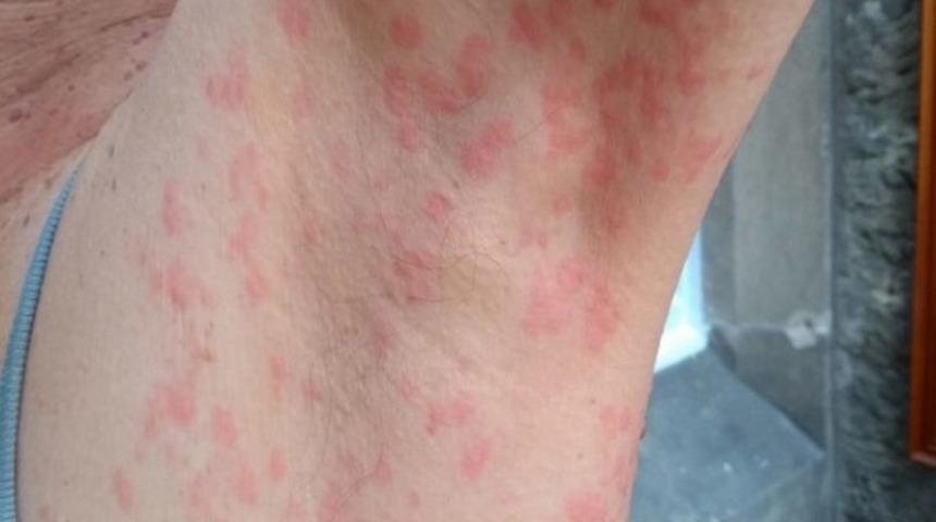 Uzmanlar deri d&ouml;k&uuml;nt&uuml;s&uuml;n&uuml; koronavir&uuml;s belirtileri arasına eklenmesi gerektiğini s&ouml;yl&uuml;yor 