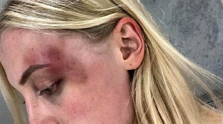 Ünlü modelin erkek arkadaşından gördüğü şiddet şoke etti!