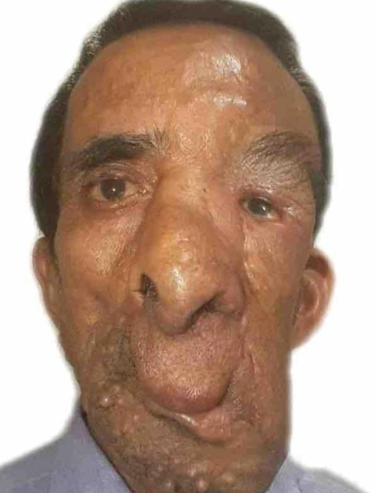 Y&uuml;z&uuml;ndeki 25 kiloluk t&uuml;m&ouml;r i&ccedil;in 5 kez bı&ccedil;ak altına yattı!