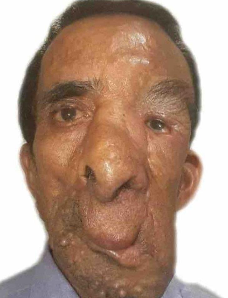 Yüzündeki 25 kiloluk tümör için 5 kez bıçak altına yattı! G1