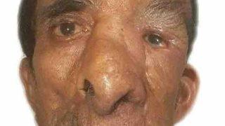 Yüzündeki 25 kiloluk tümör için 5 kez bıçak altına yattı!