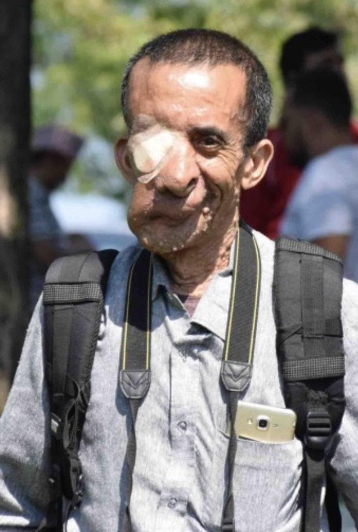 Yüzündeki 25 kiloluk tümör için 5 kez bıçak altına yattı! G2