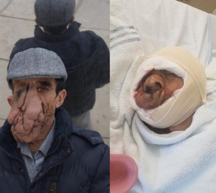 Yüzündeki 25 kiloluk tümör için 5 kez bıçak altına yattı! G3