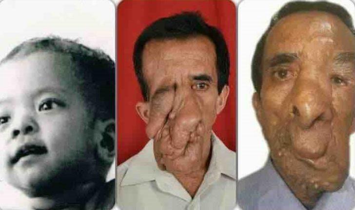 Yüzündeki 25 kiloluk tümör için 5 kez bıçak altına yattı! G4