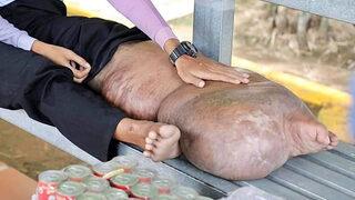 Kamboçya'da sivrisineğin ısırdığı adamın ayağı bu hale geldi