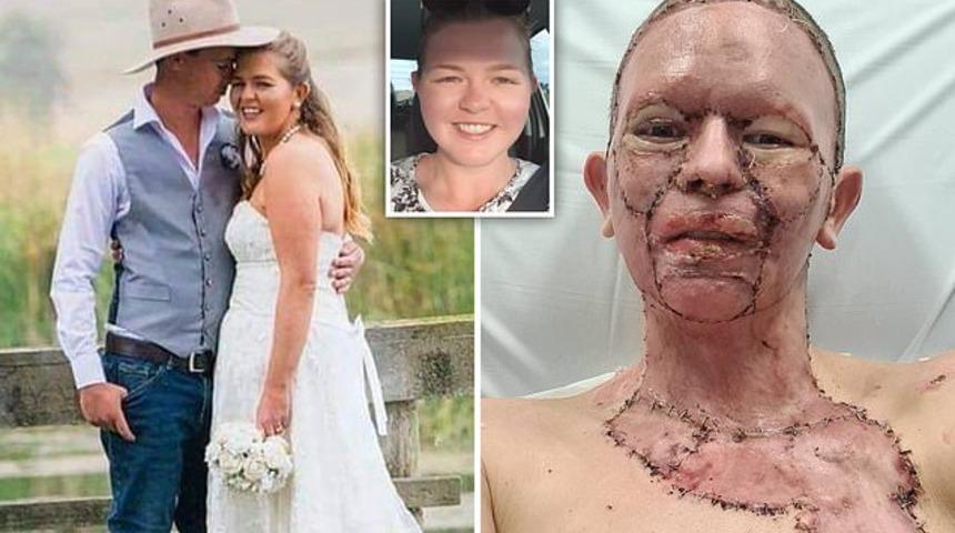 Yüzü korkunç bir şekilde yanan kadın kocasından onu terk etmesini istiyor