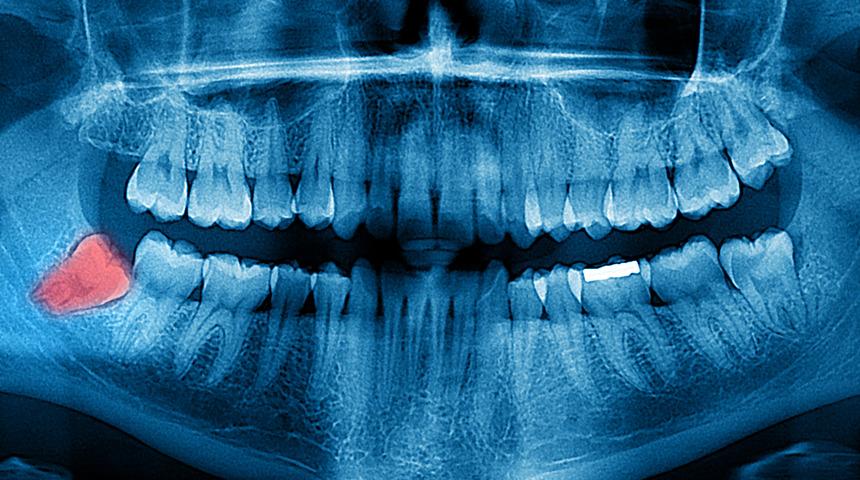 Gelecek nesiller 20 yaş dişleri olmadan doğabilir 