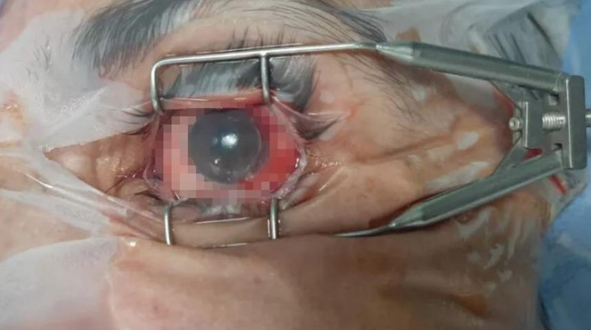 Kornea ülseri tedavisinde bebek doğum zarı yöntemi!