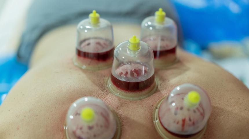 Hacamattan çıkan kanın rengi eğer böyleyse...