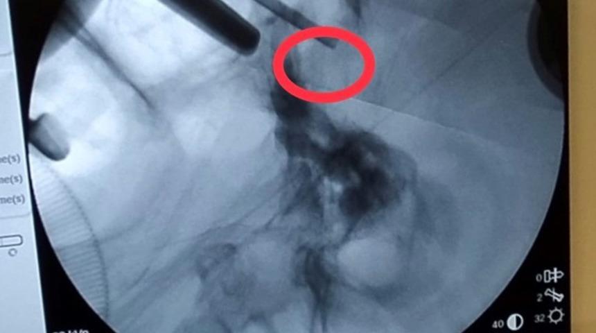 G&ouml;rme kaybı şikayetiyle hastaneye başvurdu! Burun deliğinden b&ouml;yle &ccedil;ıkardılar