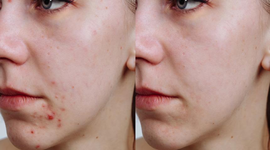 Bu ürünleri kullanıyorsanız sivilce problemi yaşayabilirsiniz!