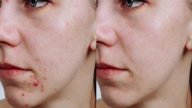 Bu ürünleri kullanıyorsanız sivilce problemi yaşayabilirsiniz!