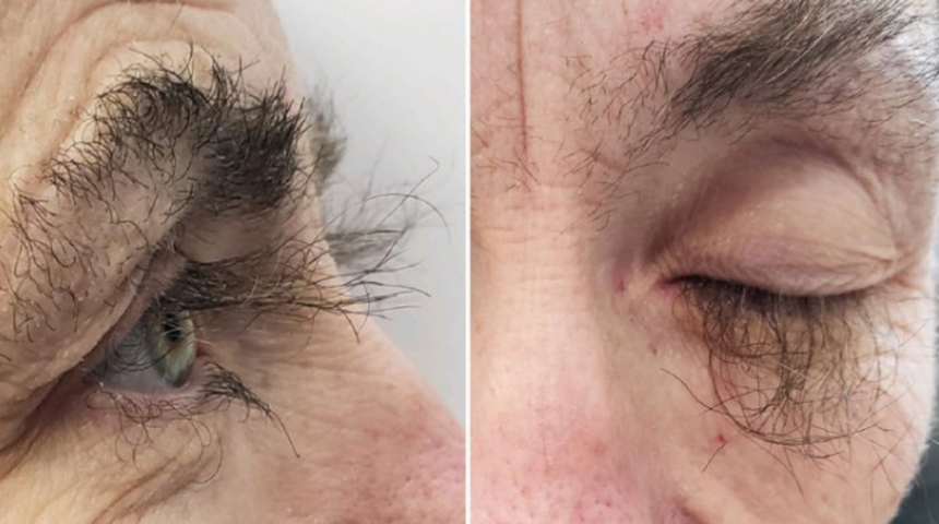 Garip ve mucizevi! Kullandığı ilaç sonrası kirpikleri uzamaya başladı